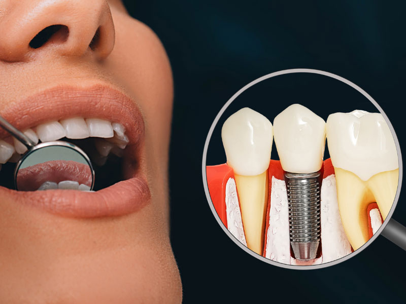 Dental Implants Lewiston