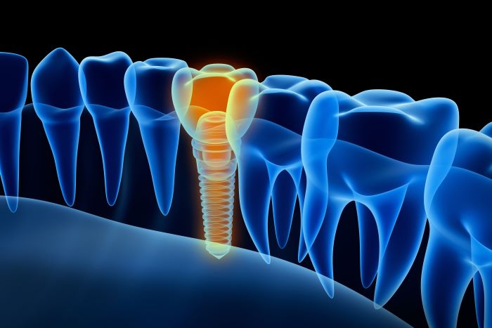 Importance of Dental Implants